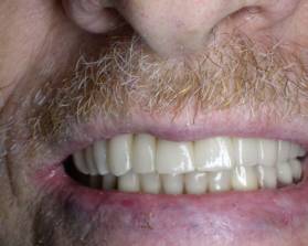 גשרי חרסינה קבועים על שתלים